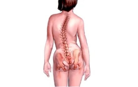 Ihe kpatara mmepe maka mmepe nke osteochondrosis cervical