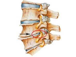 Ihe ịrịba ama na mgbaàmà nke osteochondrosis