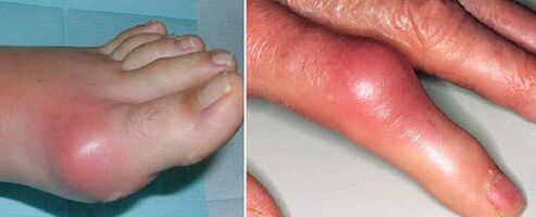 ọdịdị nkwonkwo na ọrịa ogbu na nkwonkwo