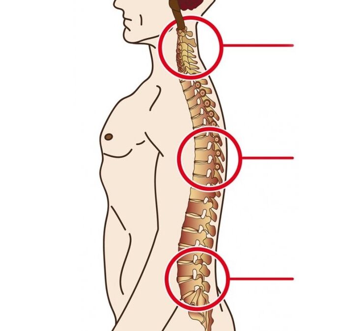 ọnọdụ nke cervical, thoracic na lumbar osteochondrosis