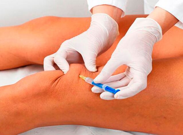 Intra-articular injections nke ọgwụ maka arthrosis nke ikpere nkwonkwo
