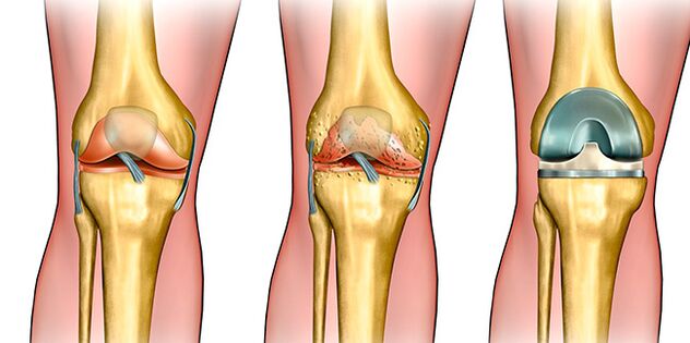 Na ọkwa nke atọ nke arthrosis, a chọrọ ngbanwe ikpere