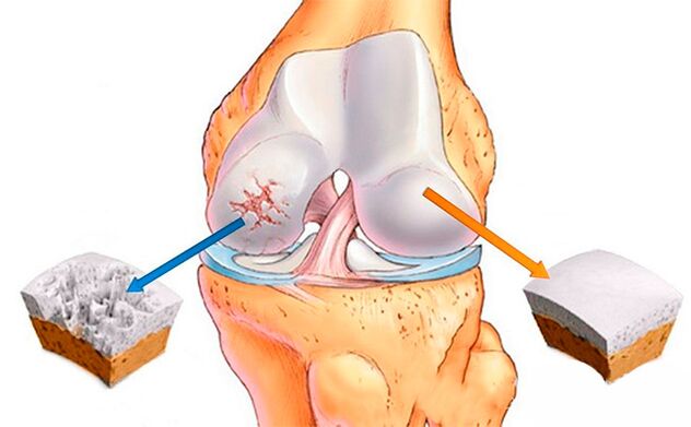 Njikọ ikpere nkịtị (n'aka nri) yana nke arthrosis na-emetụta (aka ekpe)