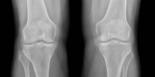 x-ray osteoarthritis ikpere