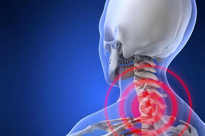 Mgbu mgbu n'olu - ihe mgbaàmà mbụ nke osteochondrosis cervical