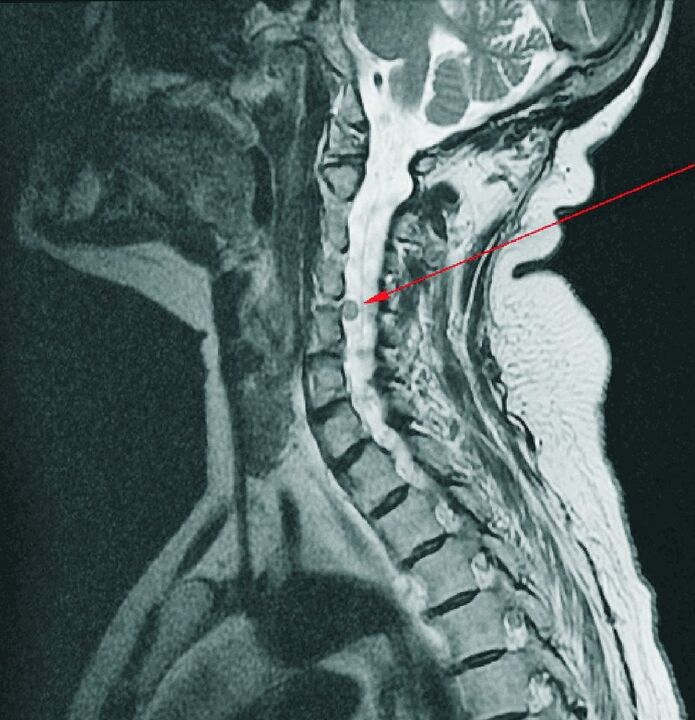 Intervertebral hernia nke spine cervical na MRI