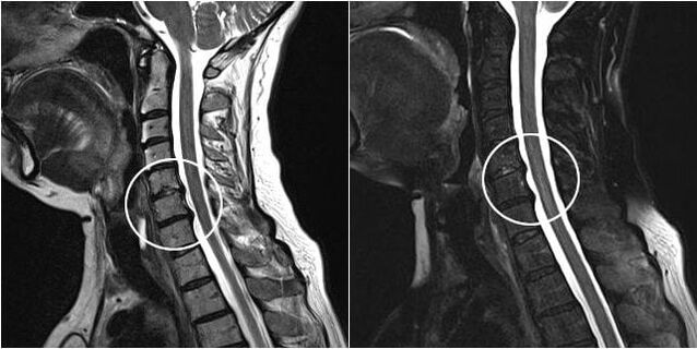 MRI nke spine cervical na ihe ịrịba ama nke osteochondrosis