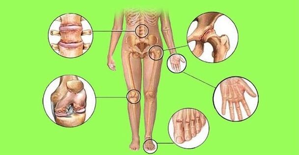 nkwonkwo na-emetụta ọrịa ogbu na nkwonkwo na arthrosis