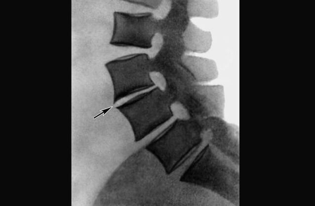 Ngosipụta nke osteochondrosis nke spine thoracic na redio