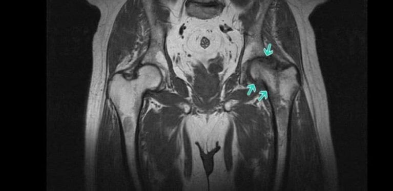 Degenerative-dystrophic mgbanwe na nkwonkwo hip na MRI