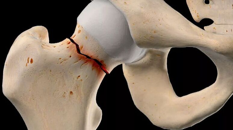 Mgbaji nke olu femoral bụ otu n'ime ihe kpatara coxarthrosis nke abụọ. 