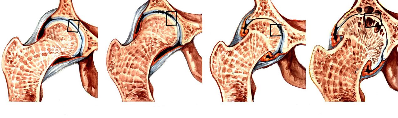 Ogo nke deforming coxarthrosis