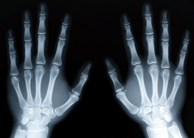 Gout na-akpalite mmepe nke ọrịa ogbu na nkwonkwo, nke a pụrụ ịchọpụta site na iji x-ray