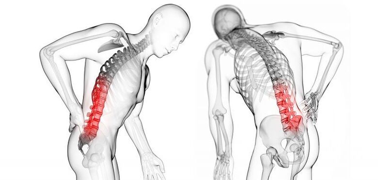 nsogbu na cervical osteochondrosis