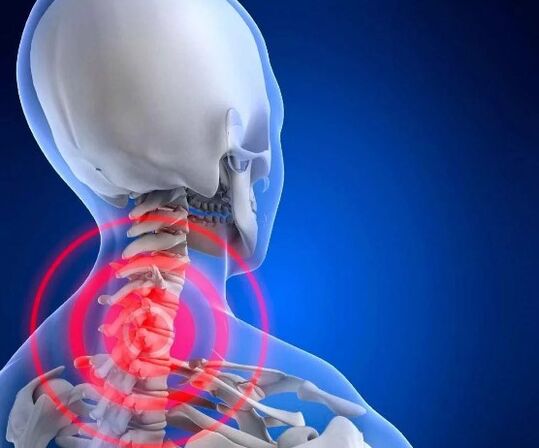Crischondrosis cervical